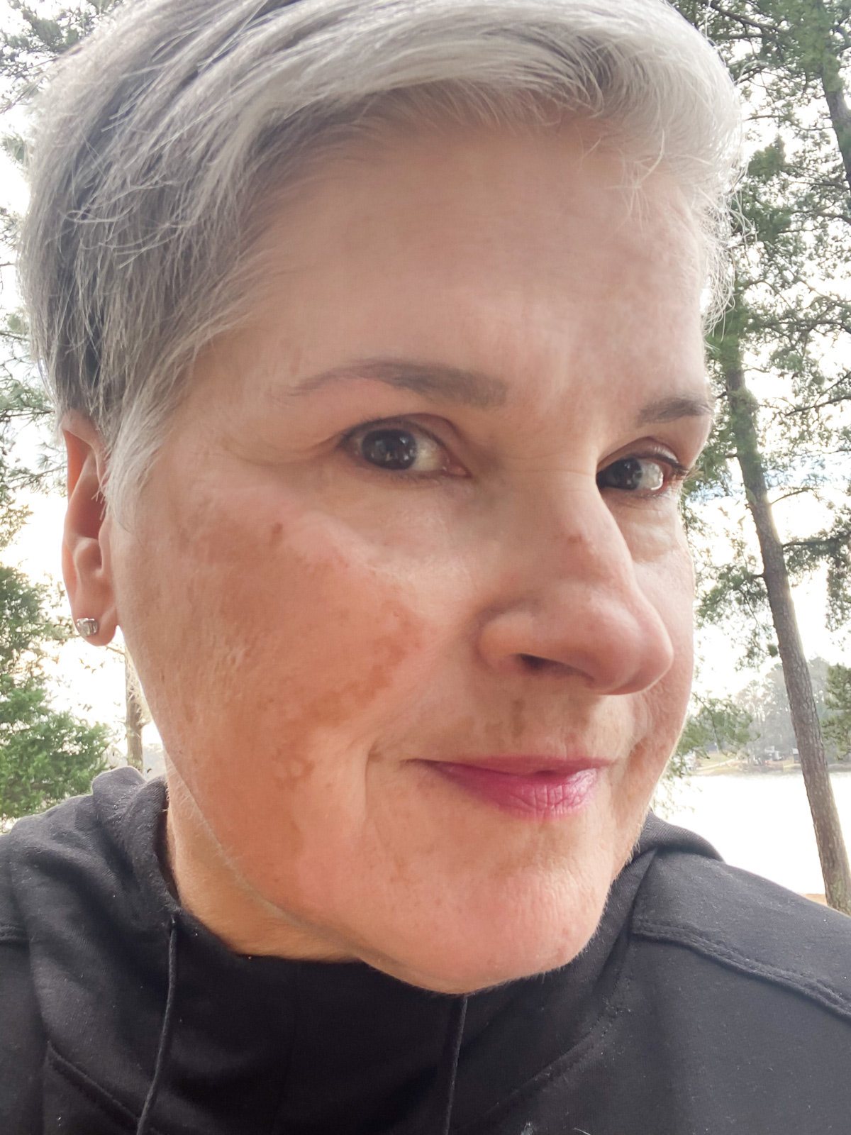 Vitiligo on face