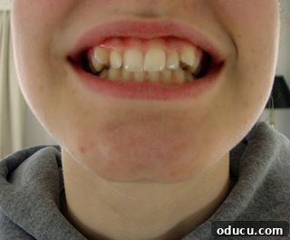 My Two Proudest DIY Achievements 18 Braces before treatment, a necessary step in their development
